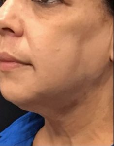 after j-plasma skin tightening face angle female patient case 2