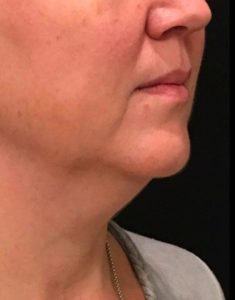 before j-plasma skin tightening face angle female patient case 1