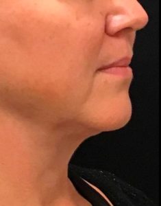 after j-plasma skin tightening face angle female patient case 1