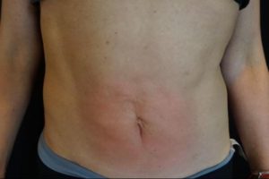 after j-plasma skin tightening stomach male patient front case 9