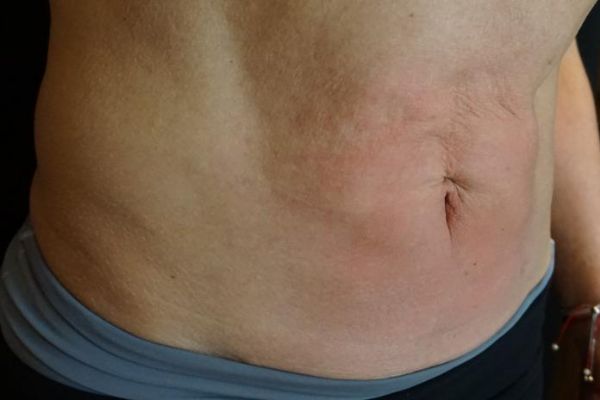 after j-plasma skin tightening stomach male patient right angle case 9