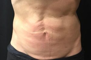 before j-plasma skin tightening stomach male patient front case 9