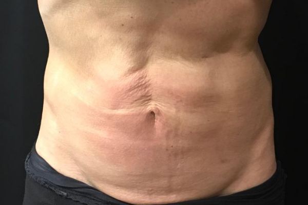 before j-plasma skin tightening stomach male patient front case 9