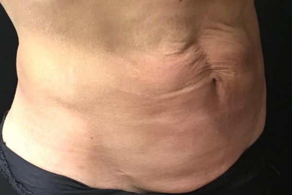 before j-plasma skin tightening stomach male patient right angle case 9