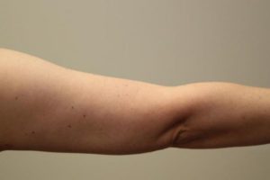 after j-plasma skin tightening arm female patient back case 8