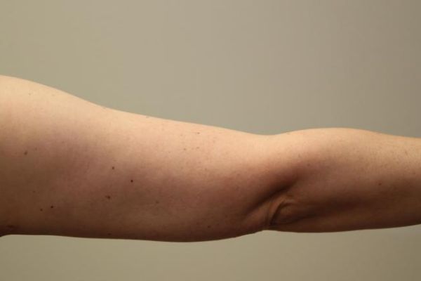 after j-plasma skin tightening arm female patient back case 8