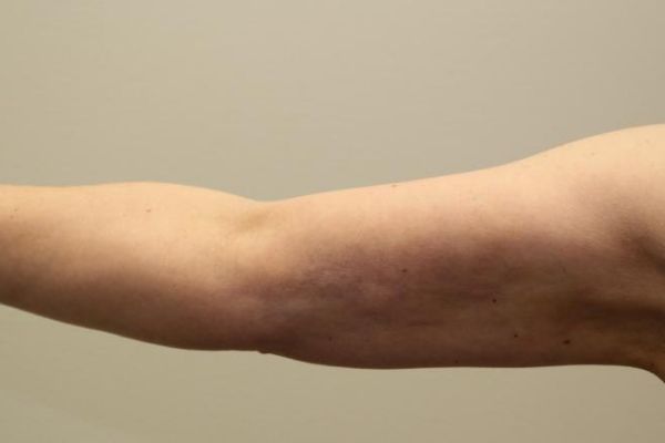 after j-plasma skin tightening arm female patient front case 8 2