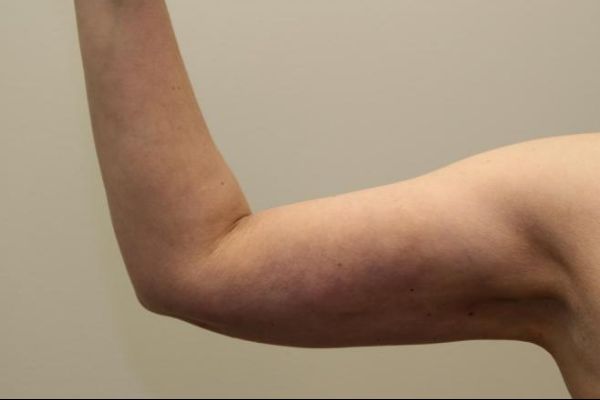 after j-plasma skin tightening arm female patient front case 8