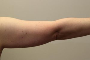 before j-plasma skin tightening arm female patient back case 8