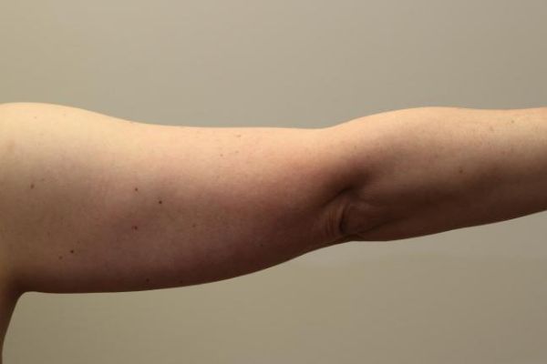 before j-plasma skin tightening arm female patient back case 8