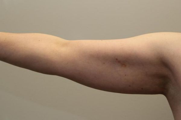 before j-plasma skin tightening arm female patient front case 8 2