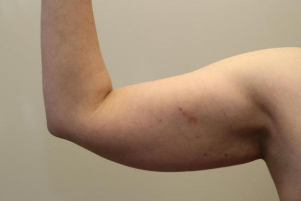 before j-plasma skin tightening arm female patient front case 8