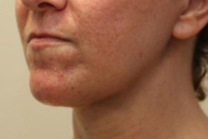after j-plasma skin tightening neck female patient angle left case 7