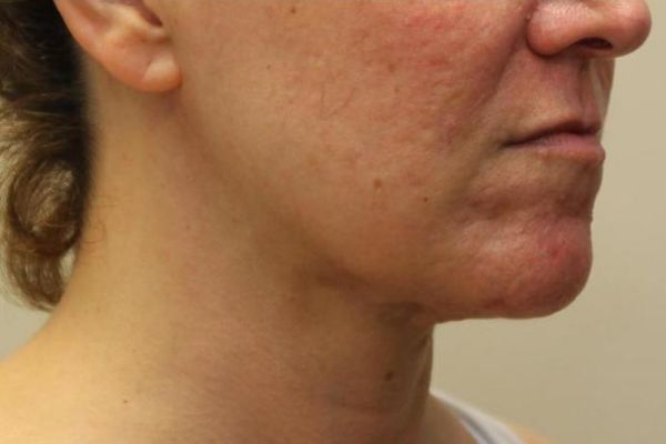 after j-plasma skin tightening neck female patient angle case 7