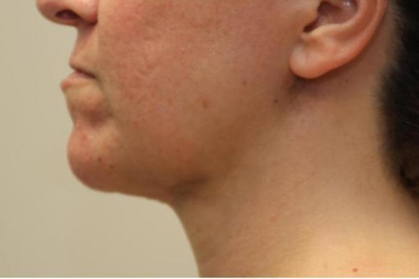 after j-plasma skin tightening neck patient side case 7