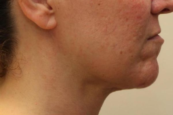 after j-plasma skin tightening neck female patient side case 7