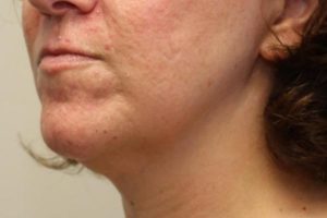 before j-plasma skin tightening neck female patient angle left case 7