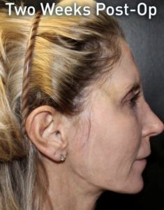 after j-plasma skin tightening face female patient side case 6