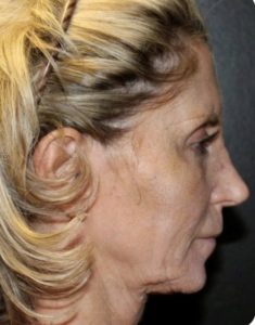 before j-plasma skin tightening face female patient side case 6