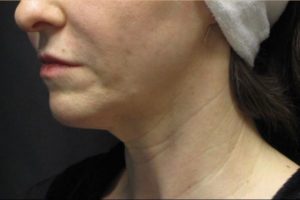 after j-plasma skin tightening face angle female patient case 4