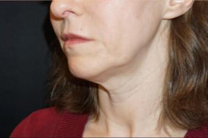 before j-plasma skin tightening face angle female patient case 4