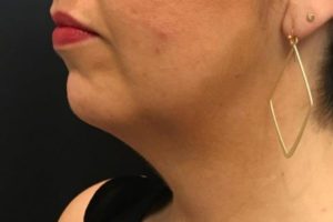 before j-plasma skin tightening face angle female patient case 3