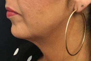 after j-plasma skin tightening face angle female patient case 3