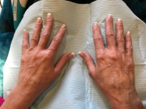 after hand filler top view both hands case 1