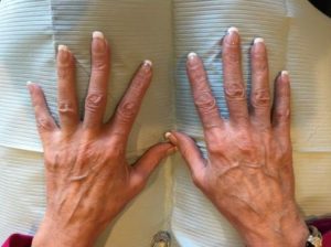 before hand filler top view both hands case 1