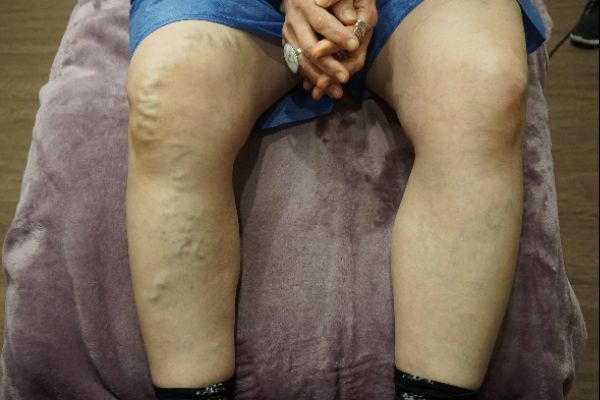before vein therapy patient 1