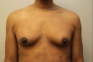 before sex reassignment top surgery front view female patient case 1