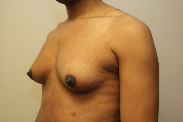 before sex reassignment top surgery left angle view female patient case 1