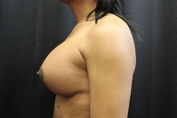 after sex reassignment top surgery left view female patient case 1