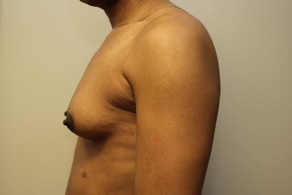 before sex reassignment top surgery left view female patient case 1