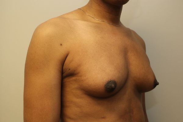before sex reassignment top surgery right angle view female patient case 1