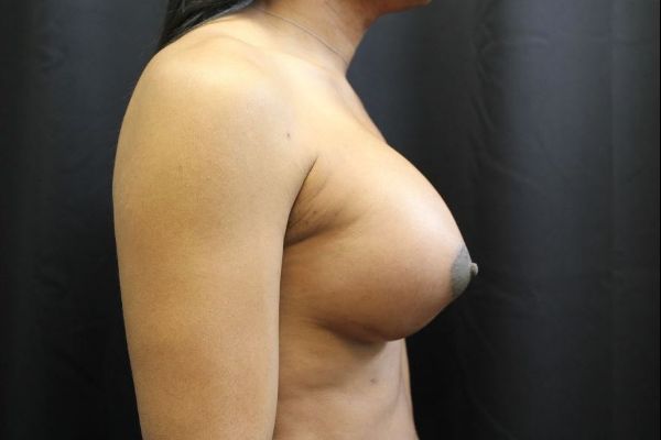 after sex reassignment top surgery right view female patient case 1