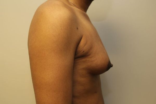 before sex reassignment top surgery right view female patient case 1