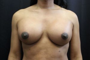 after sex reassignment top surgery front view female patient case 1