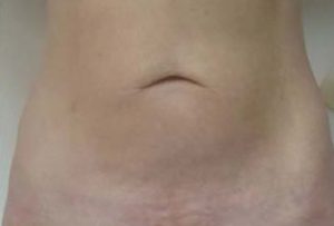 after thermirf stomach case 7
