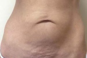 before thermirf stomach case 7