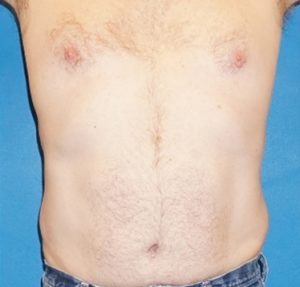 after thermirf stomach case 6