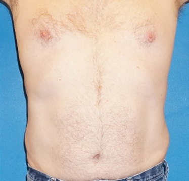 after thermirf stomach case 6