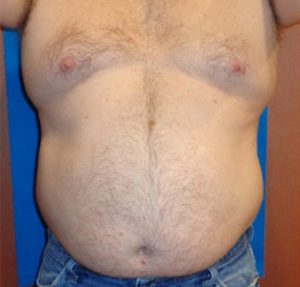 before thermirf stomach case 6