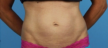 after thermirf stomach case 5
