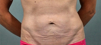 before thermirf stomach case 5