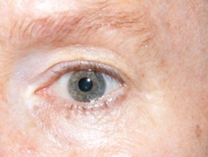 after thermirf eye area case 4