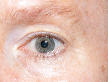 after thermirf eye area case 4