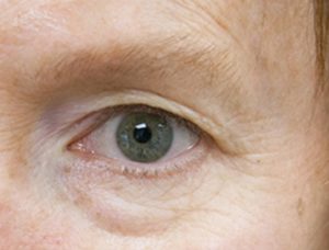 before thermirf eye area case 4
