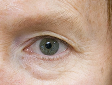 before thermirf eye area case 4