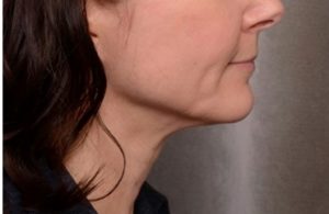 after thermirf neck area female patient side view case 3